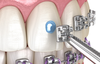 Illustration of a bracket being placed on a tooth