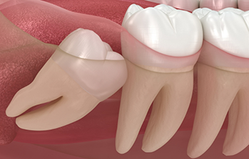 Illustration of an impacted tooth pressing against the adjacent tooth