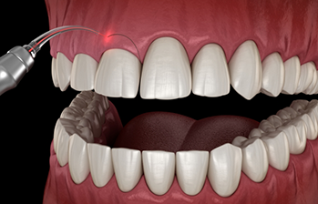 Illustration of a laser correcting an uneven gumline
