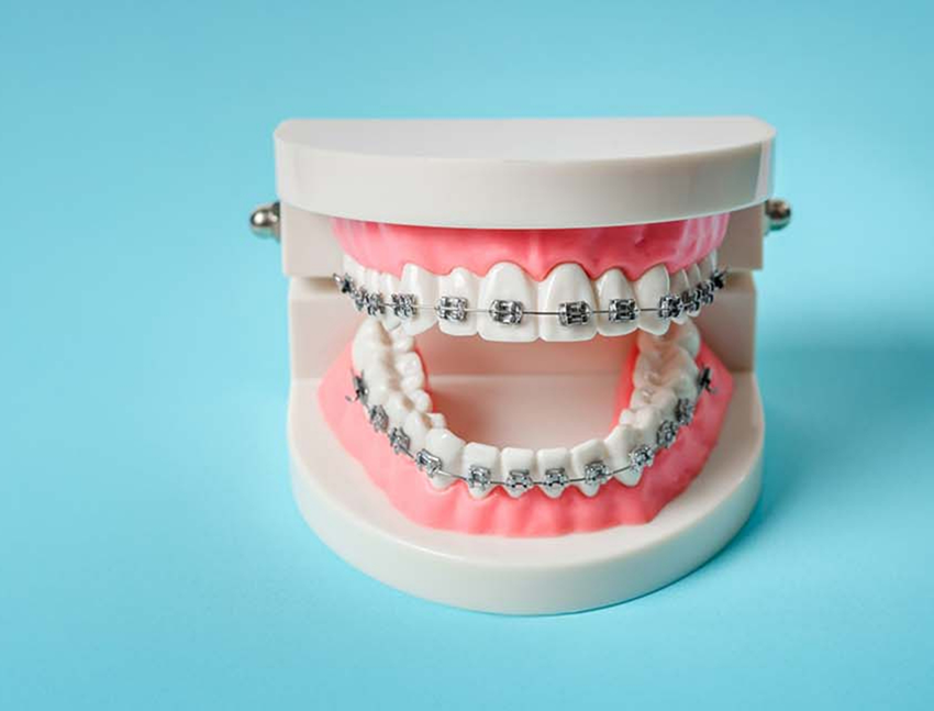Model of the teeth with Damon braces in Bend