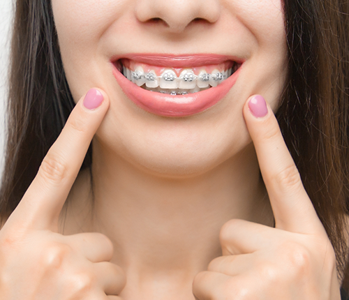 Woman with braces pointing to her smile