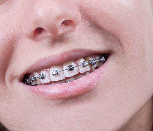 Close up of a smile with braces