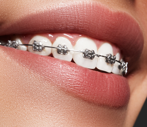 Close up of Damon braces on the upper teeth