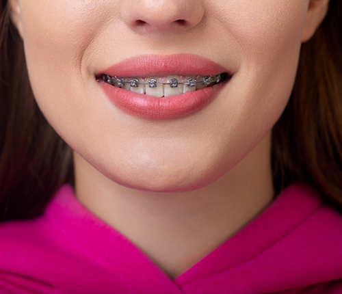 Smiling woman with Damon braces