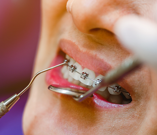Close up of a person's braces being adjusted