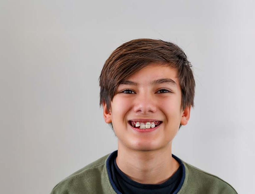 Boy smiling with a Forsus fatigue resistant appliance in Bend