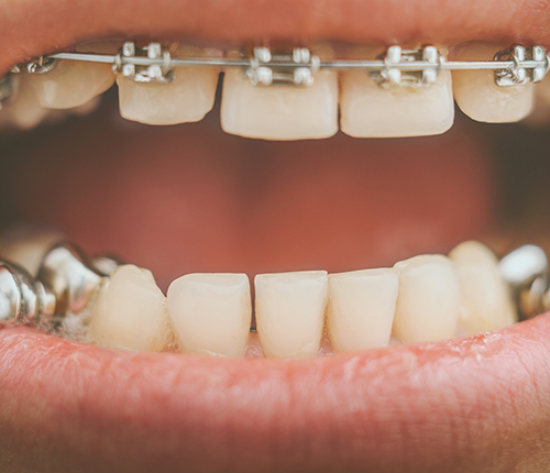 Close up of a mouth with braces and an additional metal attachment