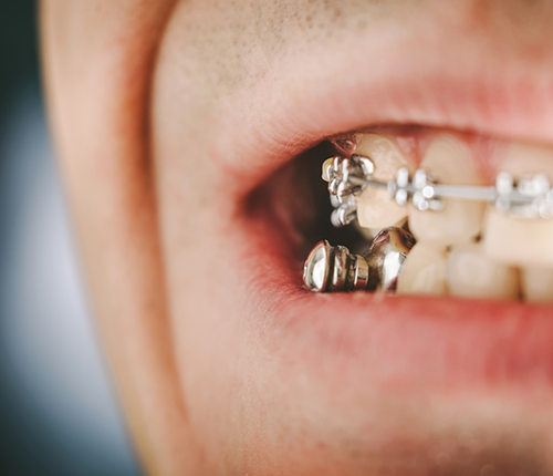 Close up of a mouth with a Forsus appliance