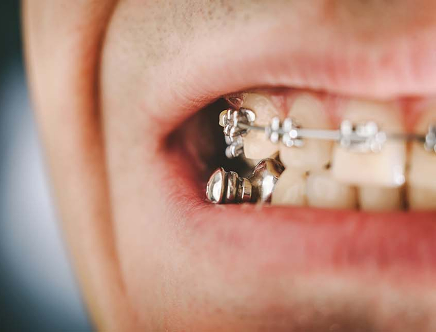 Close up of a mouth with braces and a Herbst appliance in Bend