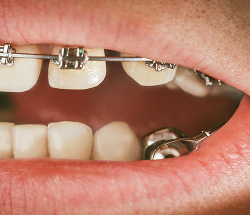 Close up of a mouth with braces and an additional metal attachment