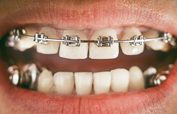 Mouth with braces on the upper arch