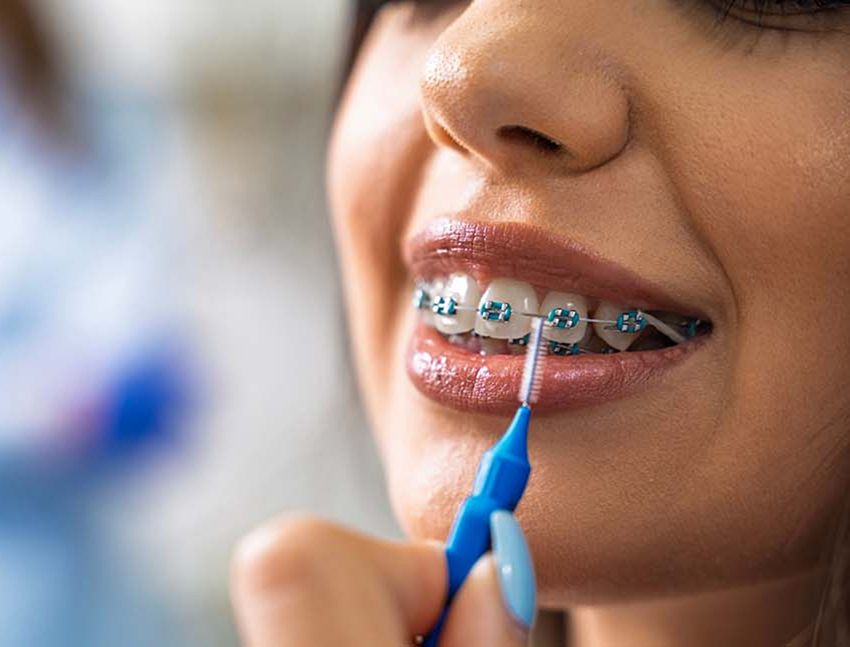 Person with braces using an interdental brush on their teeth