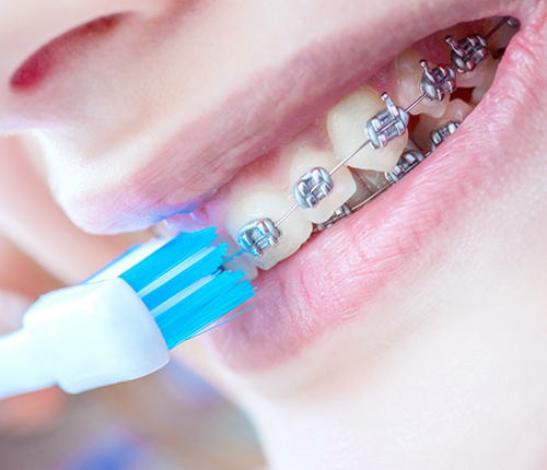 Person with braces using a traditional toothbrush