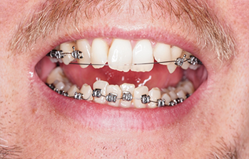 Close up of a mouth with broken braces