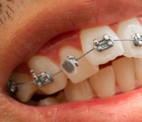 Close up of braces with a broken bracket