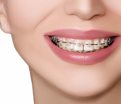 Close up of a smile with ceramic braces