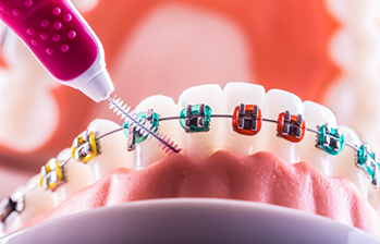 Interdental brush cleaning underneath braces