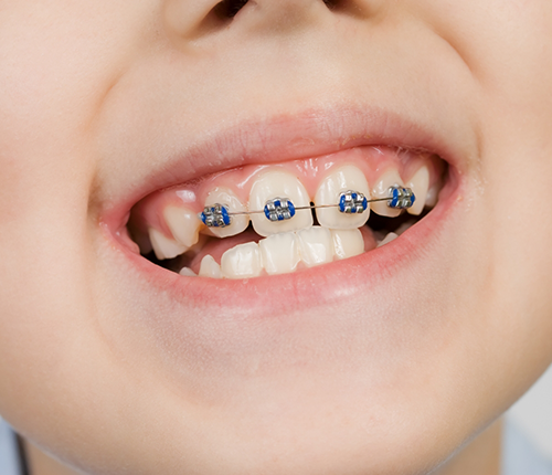 Close up of a child smiling with braces