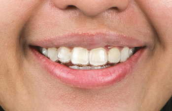 Close up of a smile with clear aligners over the teeth