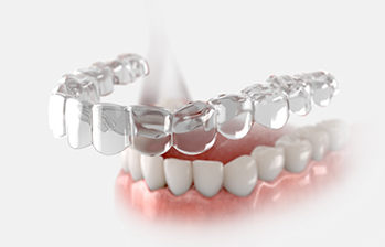 Illustration of a clear aligner being placed over a row of teeth