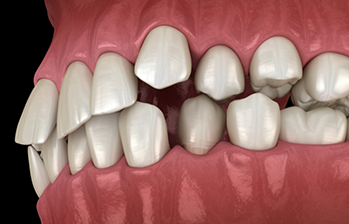 Illustrated mouth with crowded teeth