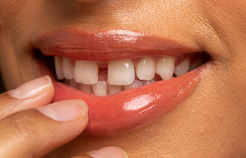 Smile with a gap between the two front teeth