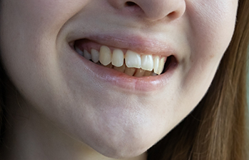 Person with an overbite smiling