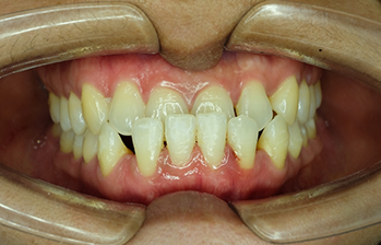 Mouth with an underbite