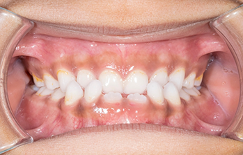 Mouth with overlapping upper and lower teeth