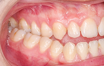 Closed mouth with some upper and lower teeth not meeting