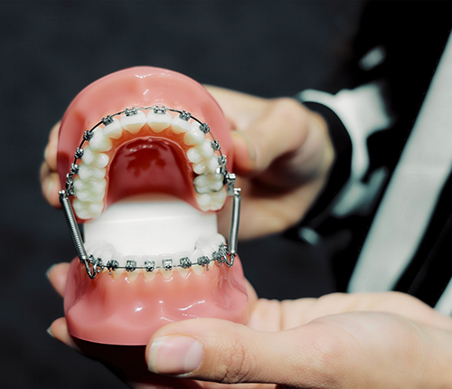 Model of the teeth with a Forsus appliance connecting the upper and lower braces