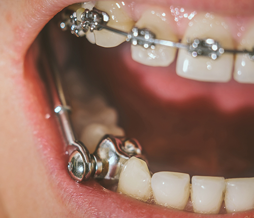 Close up of a mouth with braces with a metal attachment connecting the lower and upper arches