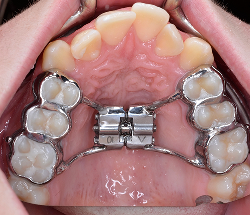 Close up of a metal expander on a person's palate