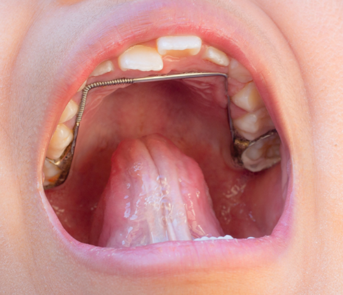 Metal wire keeping the spaces of missing teeth open