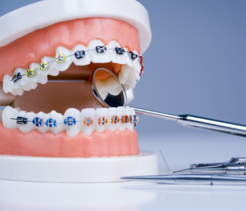 Model of the teeth with braces next to a dental mirror