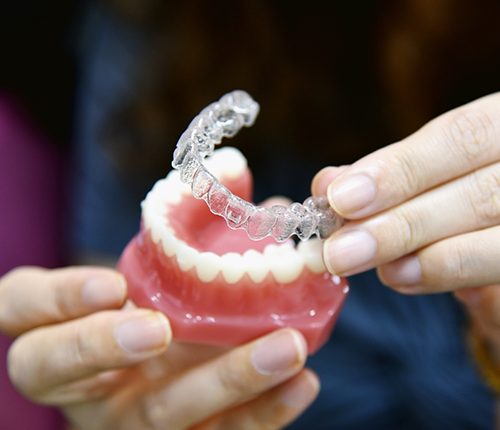 Orthodontist placing a clear aligner over a model of the teeth