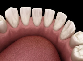 Illustration of gapped teeth in lower dental arch