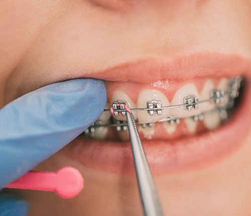 Close up of an orthodntist placing an elastic band on a patient's braces