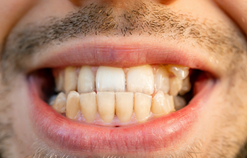 Close up of a smile with an underbite