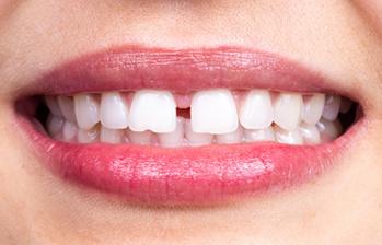 Smile with a gap between the two front teeth