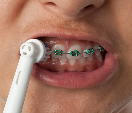 Person with braces brushing their teeth