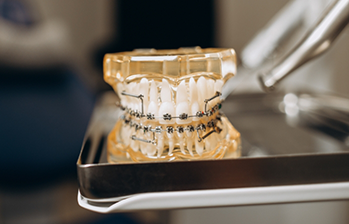 Model of the teeth with traditional braces