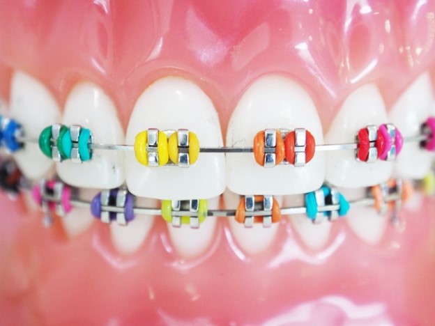 What You Need to Know About Rubber Bands and Braces