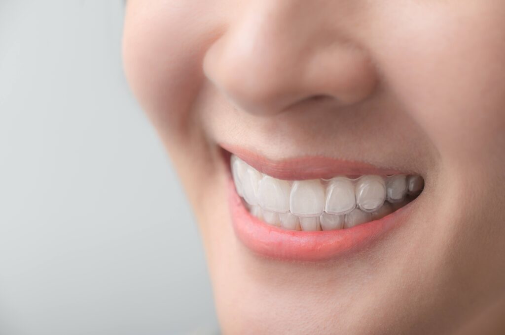 Closeup of patient with clear aligners smiling